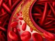 Не пропустіть! ТОП-3 ознаки, що вказують на високий рівень холестерину
